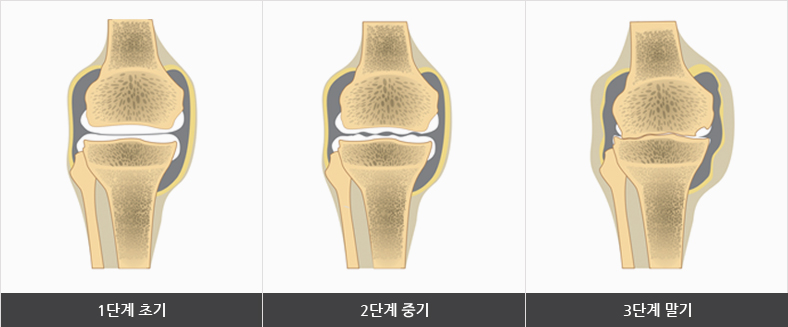 관절내 연골의 닮은 정도의 1단계 초기, 2단계 중기, 3단계 말기의 이미지